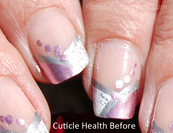 Cuticle health before using Pure™ Cuticle and Nail Oil