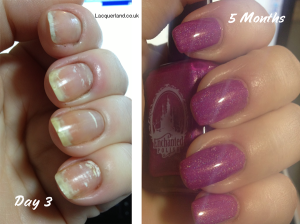 www.NailCareHQ.com White-spots-on-nails-5 month update
