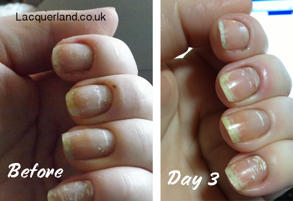 Nail abnormalities   nhs choices