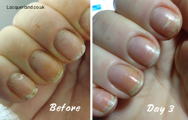 WHITE SPOTS IN NAILS – Sue's Pure Nail Oil™ Challenge | Nail Care HQ