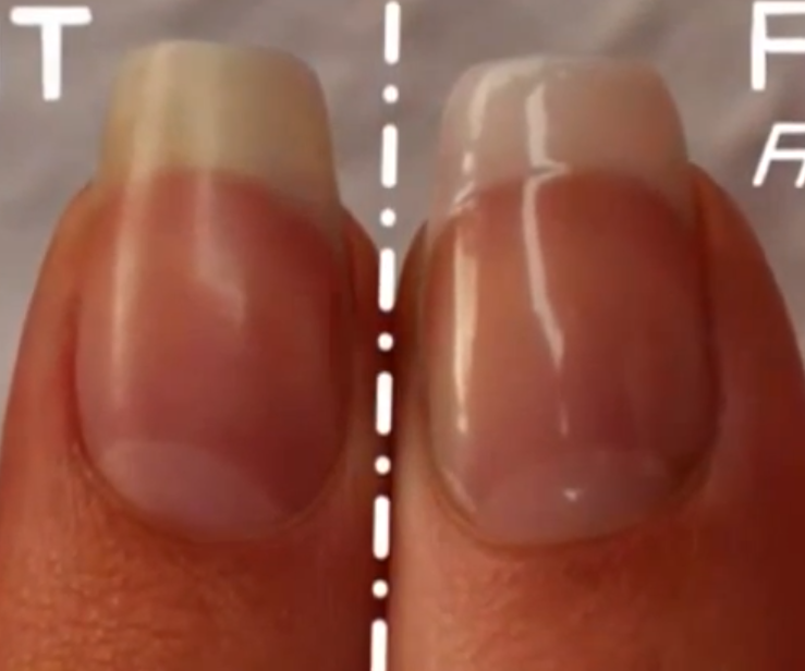 See Through Nails – Can I Fix It? | Nail Care HQ