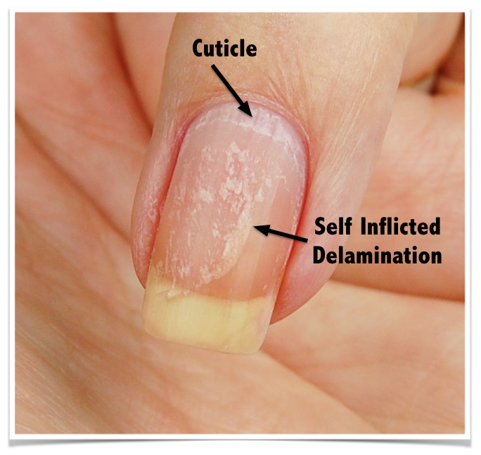 polish peeling nails cuticle  - Nail Care HQ
