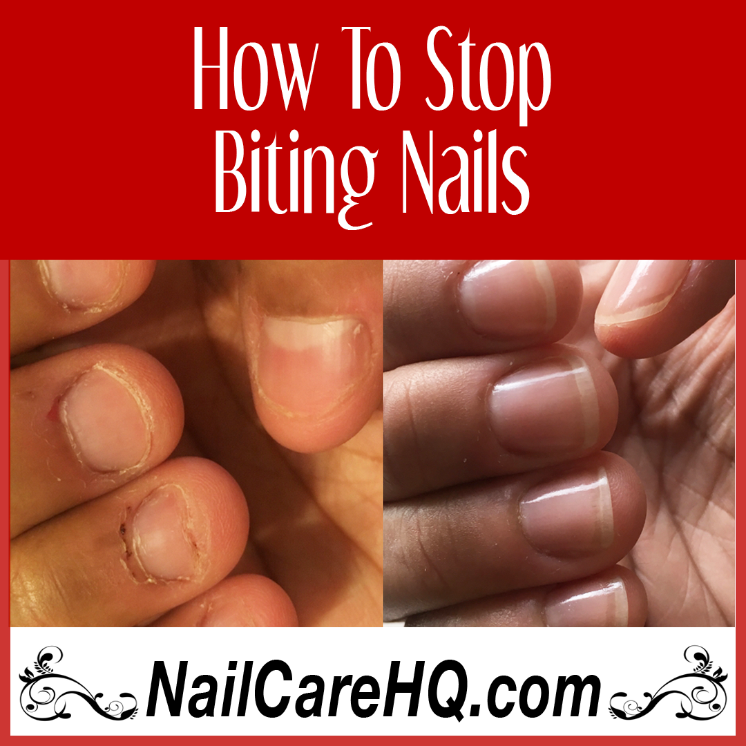 How To Stop Biting Nails – Angela's Results | Nail Care HQ